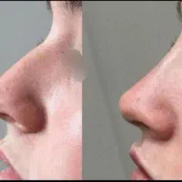 جشنواره تزریق ژل و بوتاکس در کلینیک فقط۶۰۰|خدمات آرایشگری و زیبایی|ساری, |دیوار