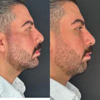 تزریق فیلر چانه