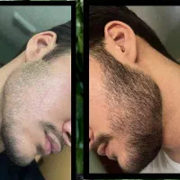 ریش نداری یا ریشات کم پشته