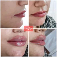 لیزر بوتاکس ژل خالبرداری|خدمات آرایشگری و زیبایی|سیرجان, |دیوار