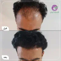 کاشت مو / شیراز / تراکم حداکثری