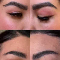 حذف تتوی صورت و بدن با لیزر