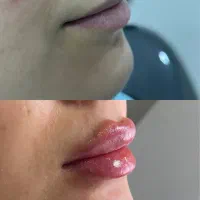 تزریق ژل و بوتاکس در مطب پزشک