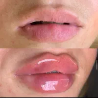 تزریق و آموزش ژل و بوتاکس مزو پی آر پی نخ و میکرو|خدمات آرایشگری و زیبایی|شیراز, ملاصدرا|دیوار