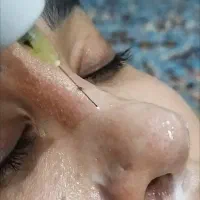 پلاسما پلکسر وقیمت باورنکردنی ۲۰۰هزار|خدمات آرایشگری و زیبایی|تهران, ارامنه|دیوار