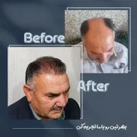 آموزش کاشت مو در مشهد