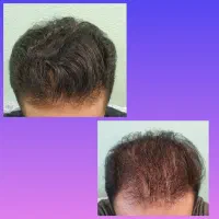 دیگه نگران ریش موهات نباش