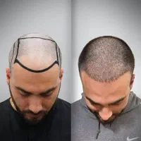 جشنواره پاییزه کاشت مو و کاشت ابرو|خدمات آرایشگری و زیبایی|تهران, دردشت|دیوار