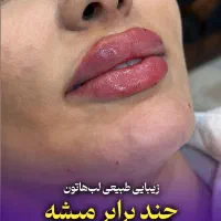 لیفت ابرو با نخ ، ژل لب ، بوتاکس توسط پزشکان متخصص|خدمات آرایشگری و زیبایی|تهران, صادقیه|دیوار