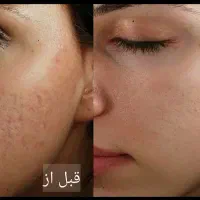 جوانسازی پوست، لیفت .بستن منافذ باز