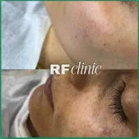 درمان و رفع تیرگی پوستی و لک