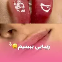 مدل تزریق ژل بوتاکس نخ میکرونیدلینگ فیشیال
