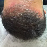 مزوتراپی مو (قطع ریزش)|خدمات آرایشگری و زیبایی|اندیشه, اندیشه فاز ۳|دیوار