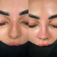 جراحی و عمل بینی|خدمات زیبایی و سلامت|کرج, عظیمیه|دیوار