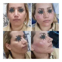 جشنواره ویژه کاشت ابرو ،بوتاکس، فیلر ..|خدمات آرایشگری و زیبایی|بوشهر, |دیوار