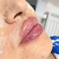 جشنواره تزریقات فیلر صورت،فیلر بادی و بوتاکس