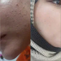 پاکسازی تخصصی پوست، مشاوره پوست و مو