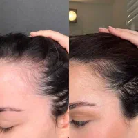 بازسازی تار های آسیب دیده
