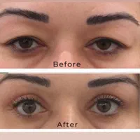 بلفاروپلاستی و رفع پف چشم ، لیفت شقیقه .جراح متخصص|خدمات آرایشگری و زیبایی|اردبیل, |دیوار