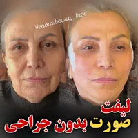 کلینیک تزریق ژلMD Codeپروفایلو-جالپرو لیفت لیزر390