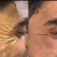 باتزریق بوتاکس5سال جوان‌ترشوتخفیف طلایی فقط تاجمعه|خدمات آرایشگری و زیبایی|اصفهان, احمدآباد|دیوار
