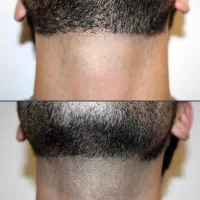 لیزر بدن فقط و فقط ۳۹۸