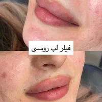 تخفیف فیلر بدن، ژل لب،بوتاکس،رفع تیرگی،ریمو تتو