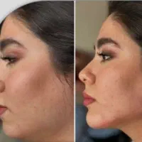 تزریق ژل و بوتاکس و کاشت نخ جوانساز