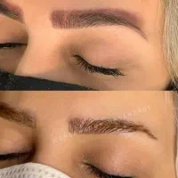 پاک کردن ریموو تتو ابرو، چشم، لب با لیزر پزشک، رشت