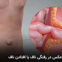 افتادگی ناف را رفع میکنیم|خدمات آرایشگری و زیبایی|اهواز, رسالت|دیوار