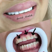 خدمات کامپوزیت مدت محدود|خدمات آرایشگری و زیبایی|اهواز, زیباشهر|دیوار