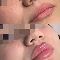 تزریق فیلر و بوتاکس ، لیزر و سفید کننده