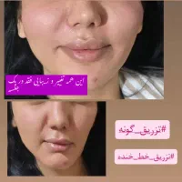 فیلر بادی ،تزریق ژل و بوتاکس با بهترین متریال قیمت|خدمات آرایشگری و زیبایی|دزفول, |دیوار