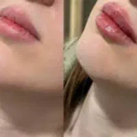 ۲۰درصد تخفیف ویژه ژل وبوتاکس