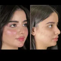 ژل وبوتاکس.برداشتن خال.فیلربینی انزیم پاککردن تاتو|خدمات آرایشگری و زیبایی|مشهد, طبرسی شمالی|دیوار
