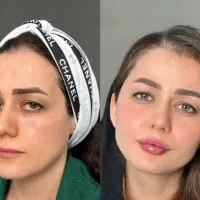 آف ویژه فیلر فول فسی  و مدلینگ صورت فقط ۳۹۰۰|خدمات آرایشگری و زیبایی|کرج, گوهردشت|دیوار
