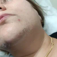 الکترولیز رفع موهای زائد هورمونی سفید و بور و کرکی