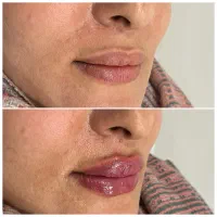 جشنواره کلینیک ژل و بوتاکس|خدمات آرایشگری و زیبایی|اصفهان, رزمندگان|دیوار