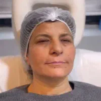 مزو،بوتاکس،فیلر،