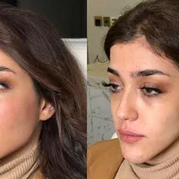 تزریق ژل و بوتاکس طراحی چهره برای زیبایی‌خاص|خدمات آرایشگری و زیبایی|تهران, شادمان|دیوار