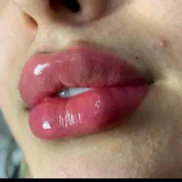 تزریق آموزش ژل بوتاکس چربی