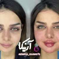 جشنواره تخفیف 50درصدی ژل و بوتاکس