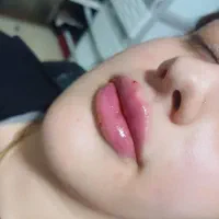 آف ویژه ژل بوتاکس مزو|خدمات آرایشگری و زیبایی|اسلامآباد غرب, |دیوار