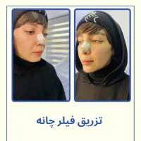 فیلر لب روسی -زاویه سازی -بوتاکس-پی ار پی -مزو|خدمات آرایشگری و زیبایی|تهران, دریا|دیوار