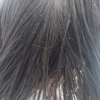 پاکسازی رشک و شپش موی سر در شهرک شهید رجایی