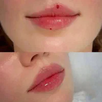 خدمات تخصصی فیلر و بوتاکس ومزوتراپی|خدمات آرایشگری و زیبایی|شاهینشهر, فردوسی|دیوار