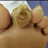 درمان دیابت به صورت تخصصی تضمینی (صدرصدی)