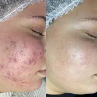 خروج لک و کک مک جای جوش با درمان تلفیقی|خدمات آرایشگری و زیبایی|سبزوار, کاشفی شمالی (دادگستری)|دیوار