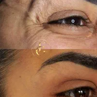 بوتاکس چشم گربه ای تضمینی پی ار اف آنزیم|خدمات آرایشگری و زیبایی|کرج, گوهردشت|دیوار