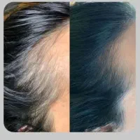 قطع ریزش مو و پرپشتی مو فقط با تکنیک اکسونیک|آرایشی، بهداشتی، درمانی|بوشهر, |دیوار